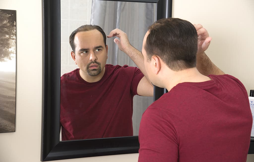 receding-hairline-is-male-pattern-baldness
